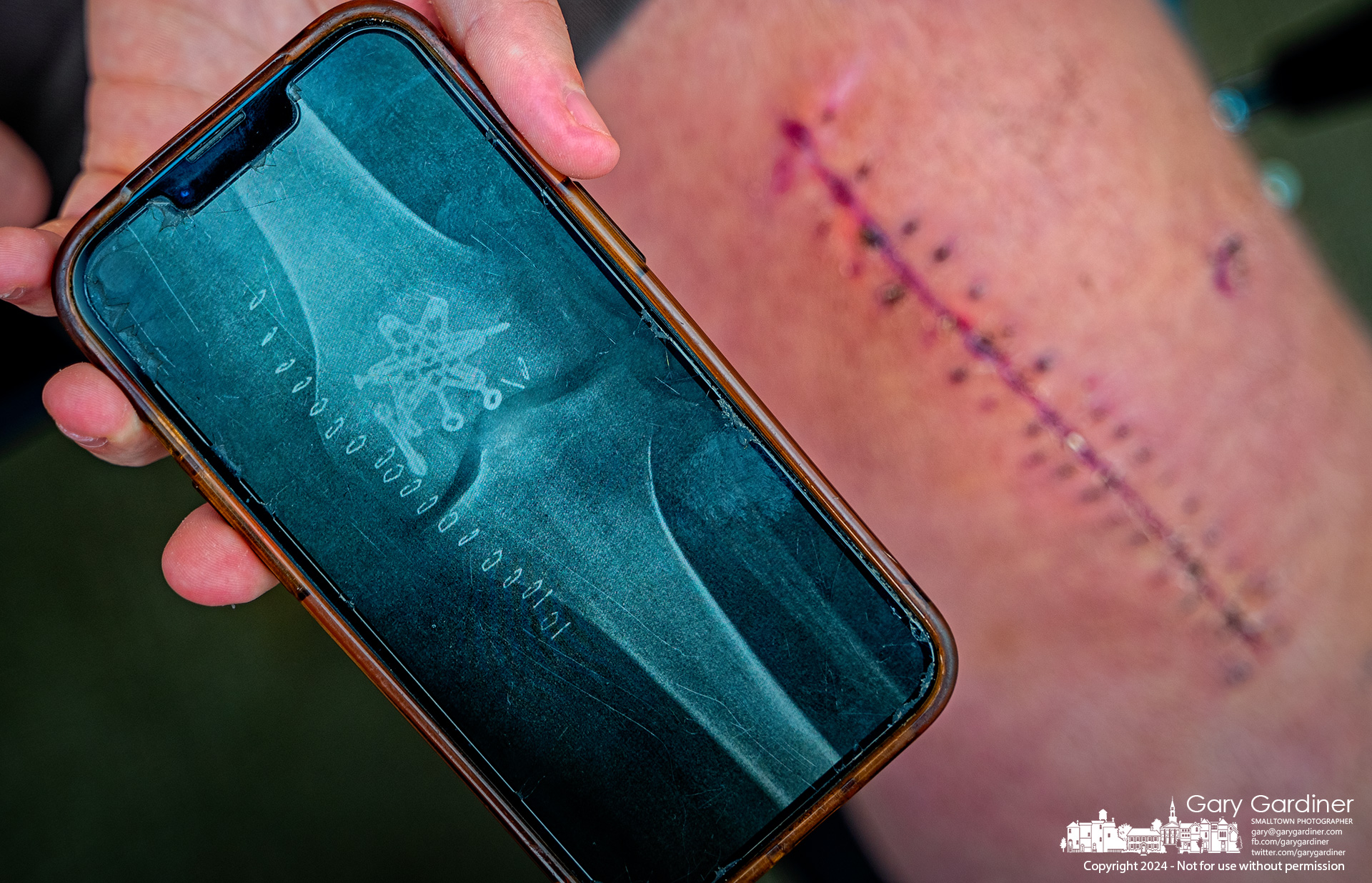 The metal plates, pins, and screws that rebuilt his knee are shown on a phone held next to the surgery scar and exit wound from an accidental shooting. My Final Photo for November 6, 2024.